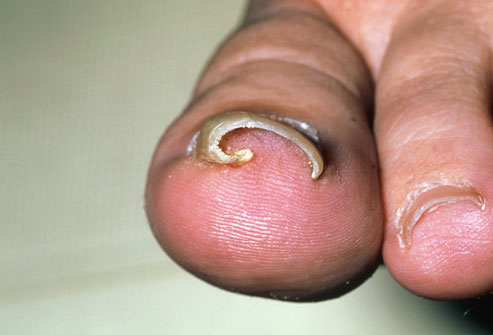 Ingrown Toenails - Almawi Limited The Holistic Clinic