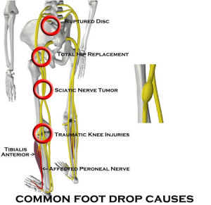Foot drop  Physio Check
