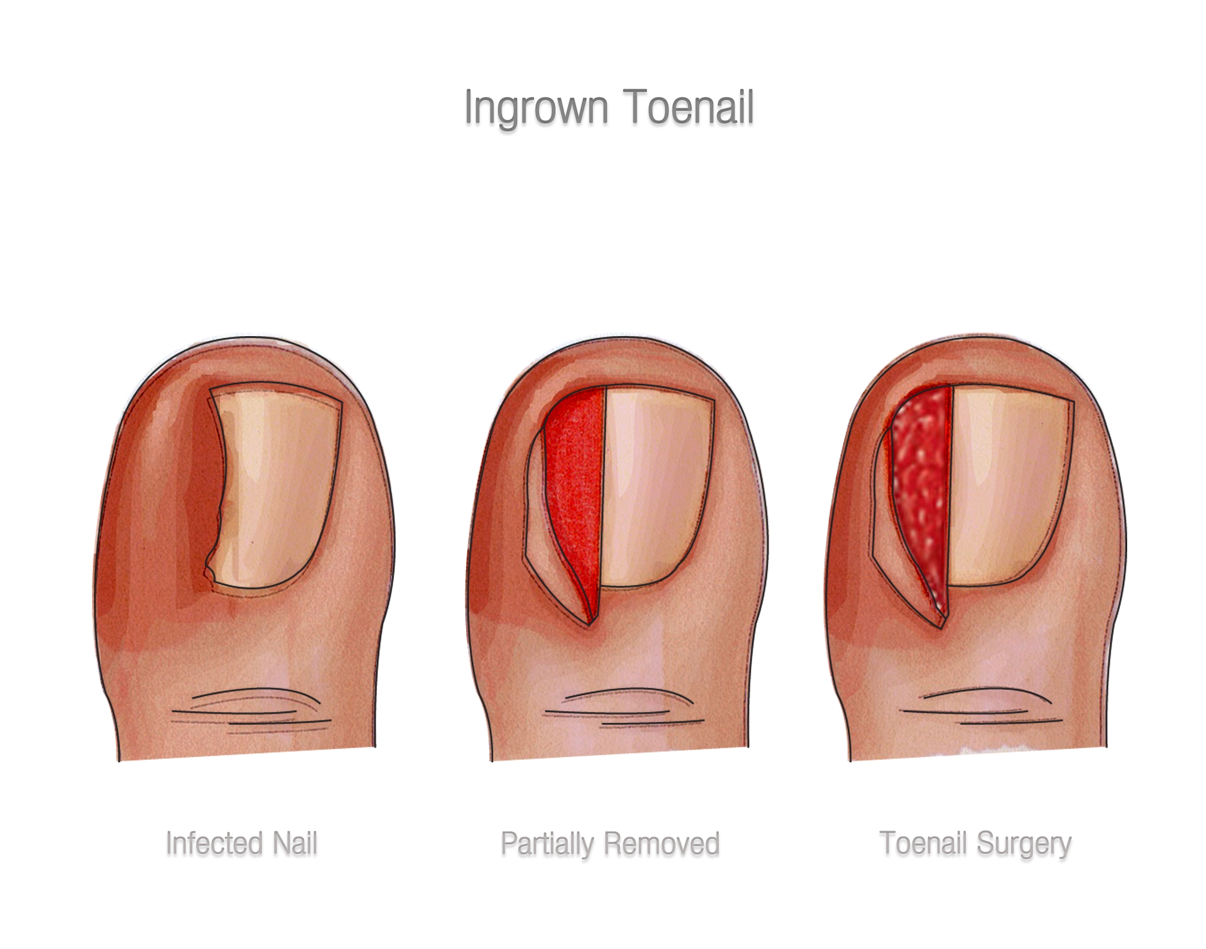 Ingrown Toenails Salon Geek Salon Professionals Forum