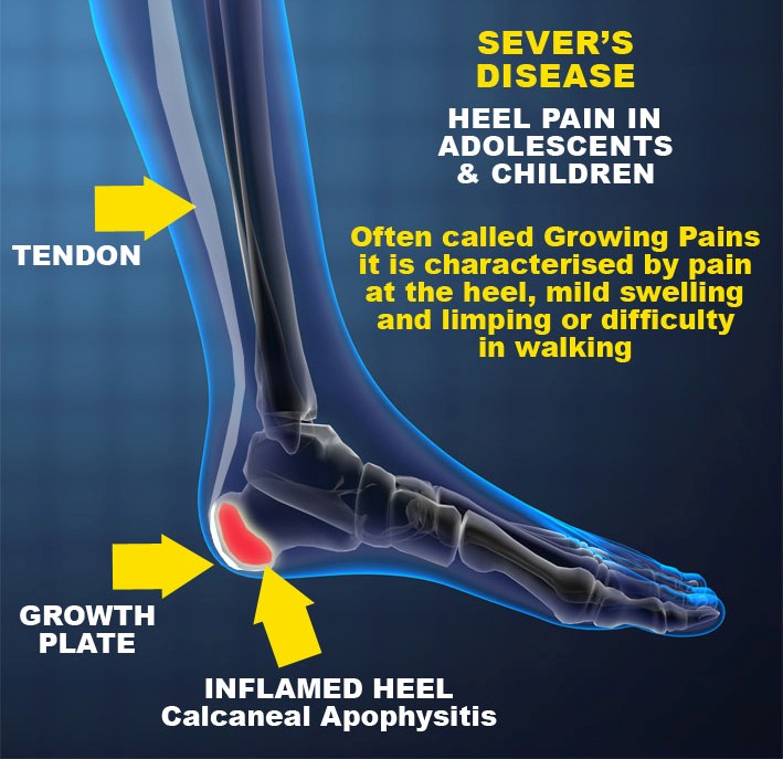 heel pain in 8 year old