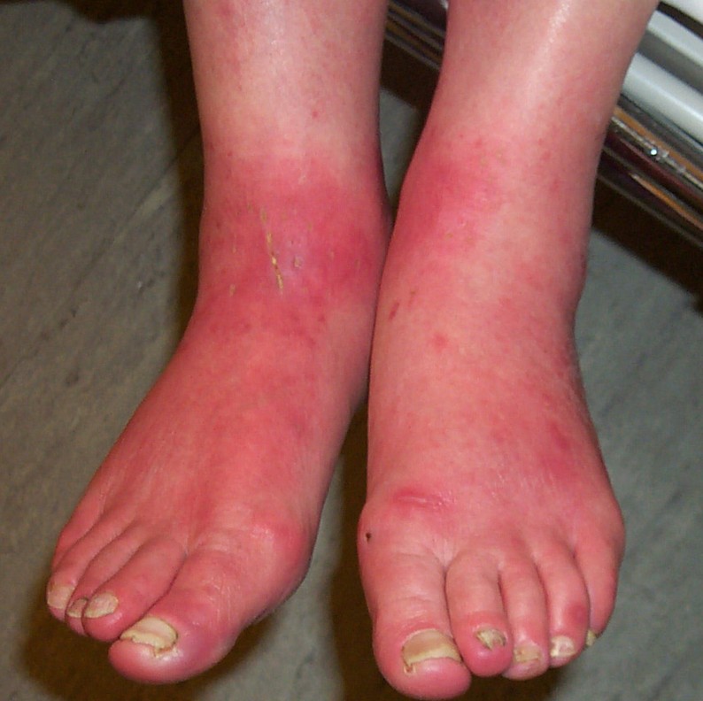 Grierson Gopalan Syndrome Burning Feet Syndrome Almawi Limited The 