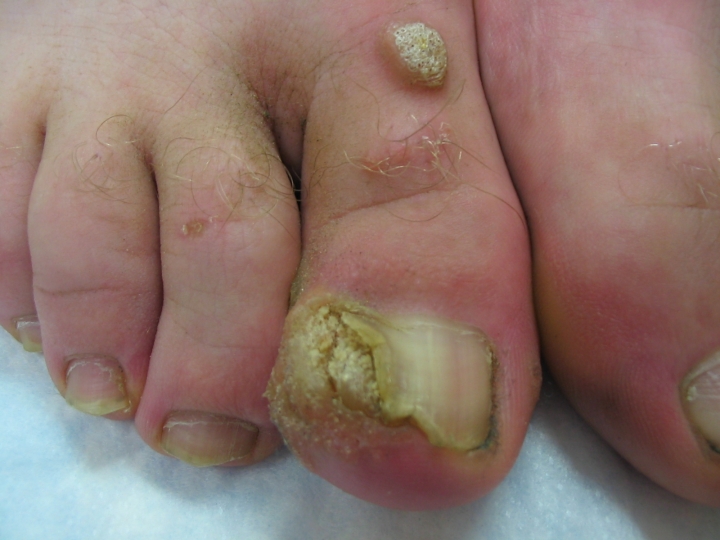 warts foot nails)