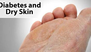 causes of dry feet skin