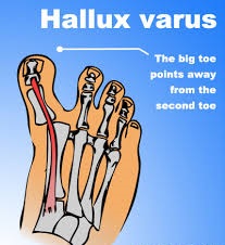 Difference Between Hallux Varus And Hallux Valgus - Almawi Limited The ...