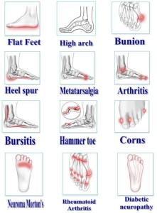 What is Equinus Foot? - Almawi Limited The Podiatry Clinic