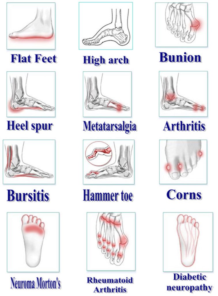 What is Equinus Foot? - Almawi Limited The Holistic Clinic