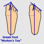 What is Morton's Toe? - Almawi Limited The Holistic Clinic